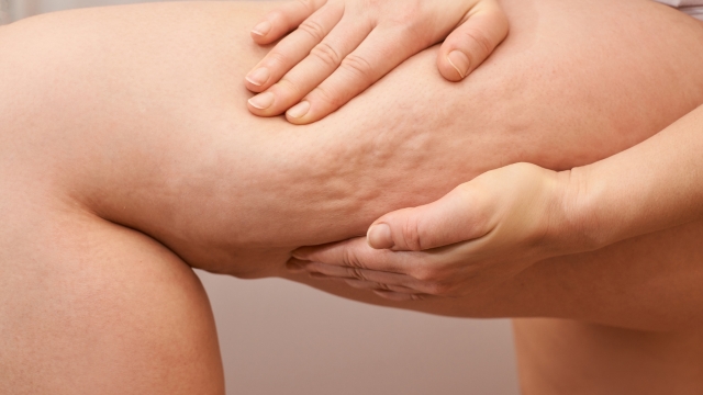 Žena pritiskom na butinu pokazuje celulit nastao u trudnoći